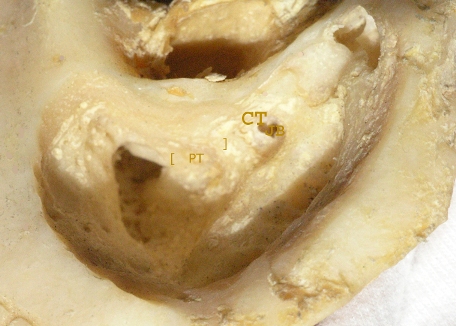 Temp bone